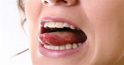 lingua queimada - cancer na lingua
